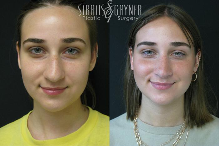 Before & After Rhinoplasty Case 208 View #3 View in Harrisburg, PA