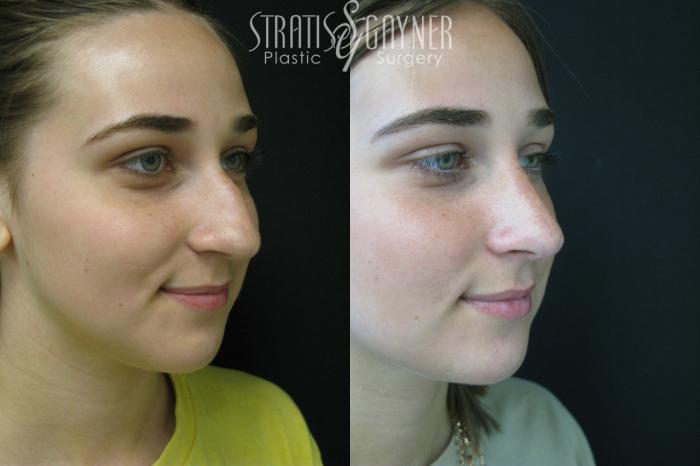 Before & After Rhinoplasty Case 208 View #4 View in Harrisburg, PA