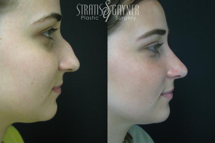 Before & After Rhinoplasty Case 208 View #5 View in Harrisburg, PA