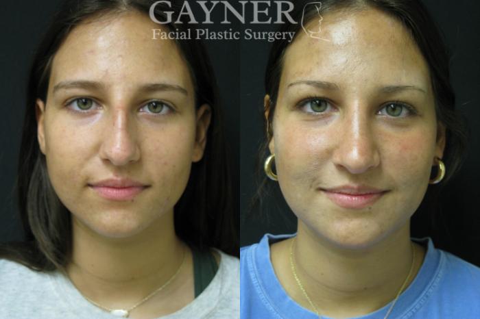 Before & After Rhinoplasty Case 226 Front View in Harrisburg, PA
