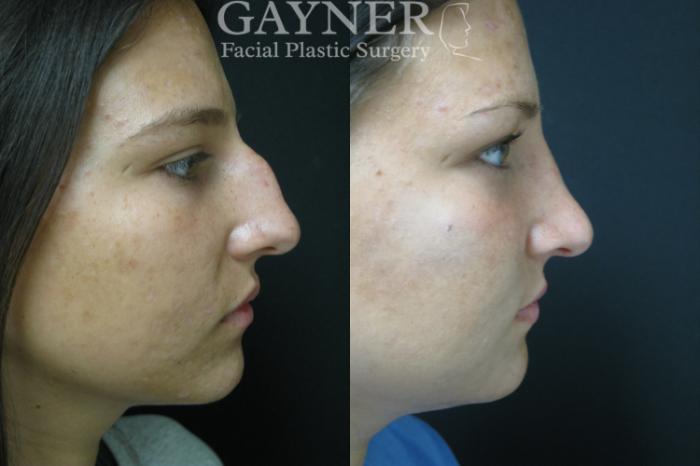 Before & After Rhinoplasty Case 226 Right Side View in Harrisburg, PA