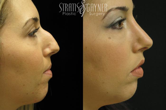 Before & After Rhinoplasty Case 37 View #1 View in Harrisburg, PA