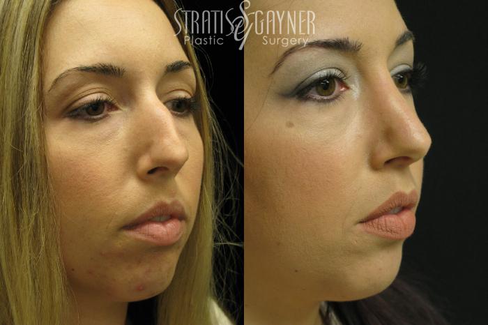 Before & After Rhinoplasty Case 37 View #2 View in Harrisburg, PA