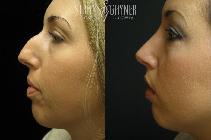 Before & After Rhinoplasty Case 37 View #3 View in Harrisburg, PA