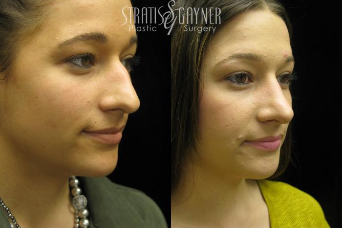 Before & After Rhinoplasty Case 38 View #1 View in Harrisburg, PA