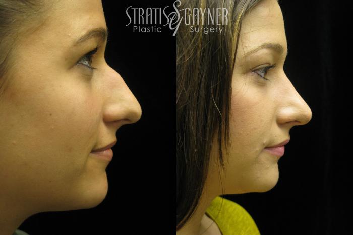 Before & After Rhinoplasty Case 38 View #2 View in Harrisburg, PA