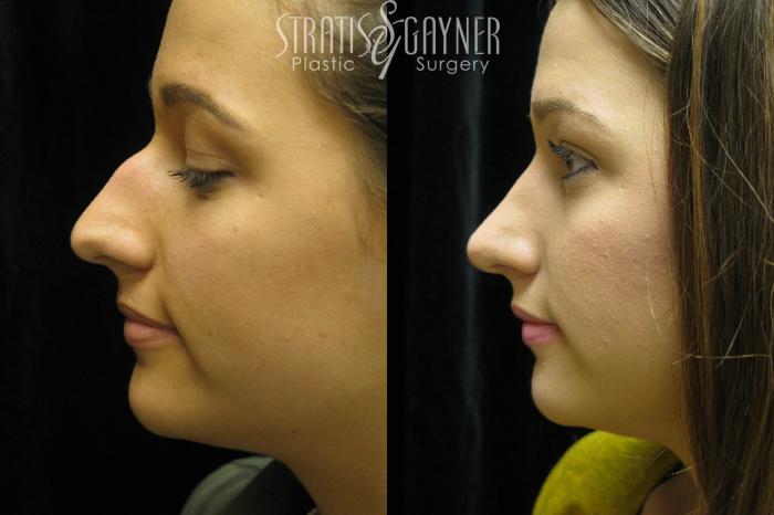 Before & After Rhinoplasty Case 38 View #3 View in Harrisburg, PA