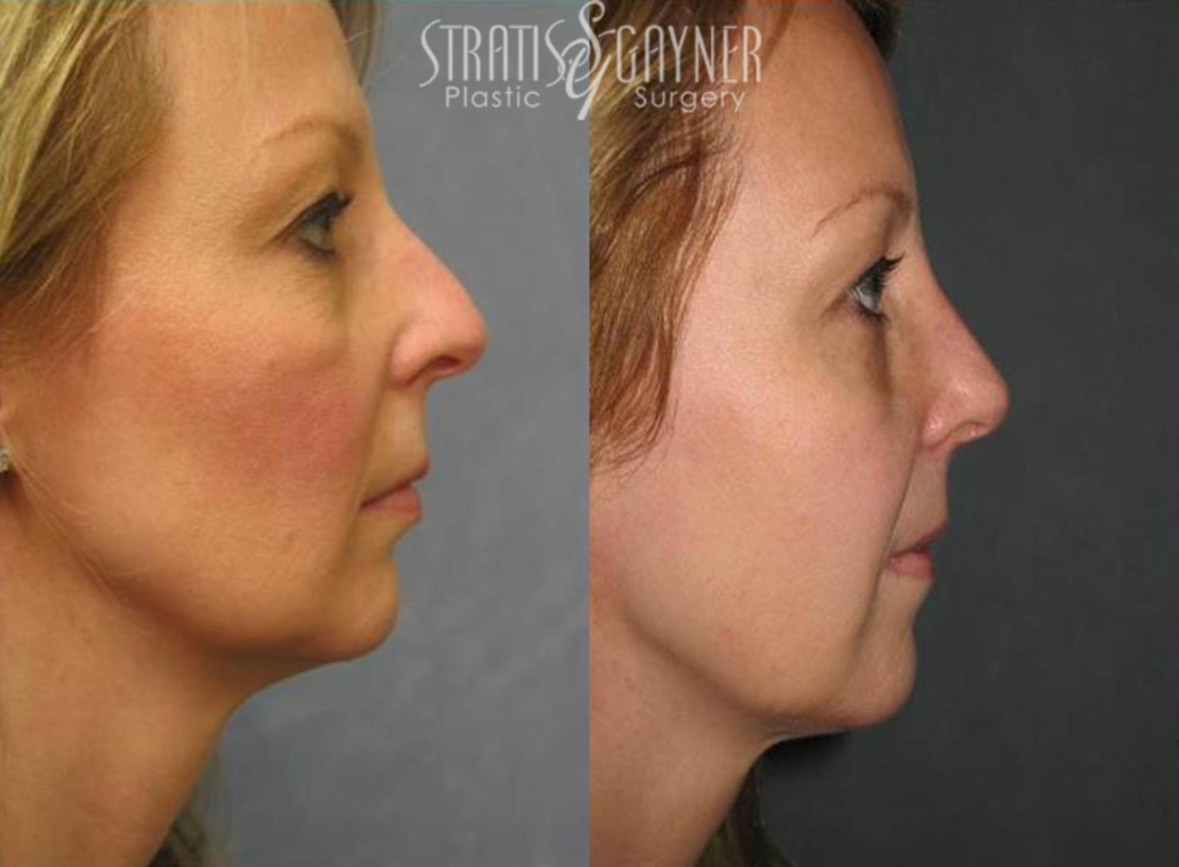 Before & After Rhinoplasty Case 61 View #1 View in Harrisburg, PA