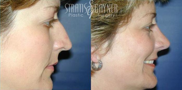 Before & After Rhinoplasty Case 62 View #1 View in Harrisburg, PA