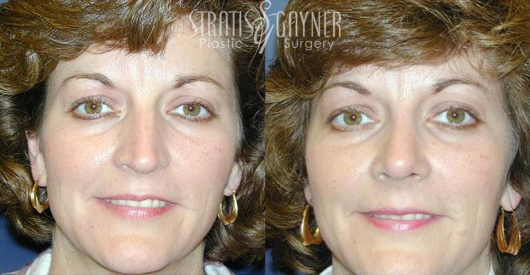 Before & After Rhinoplasty Case 63 View #1 View in Harrisburg, PA