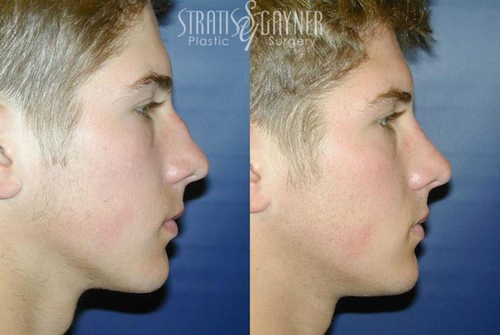 Before & After Rhinoplasty Case 64 View #1 View in Harrisburg, PA