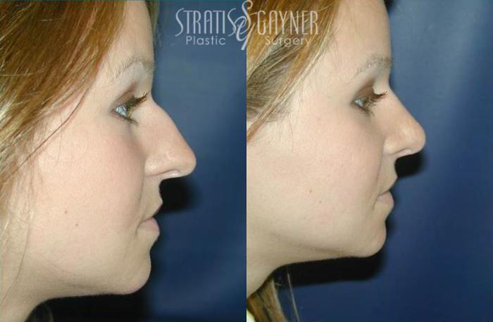 Before & After Rhinoplasty Case 65 View #1 View in Harrisburg, PA