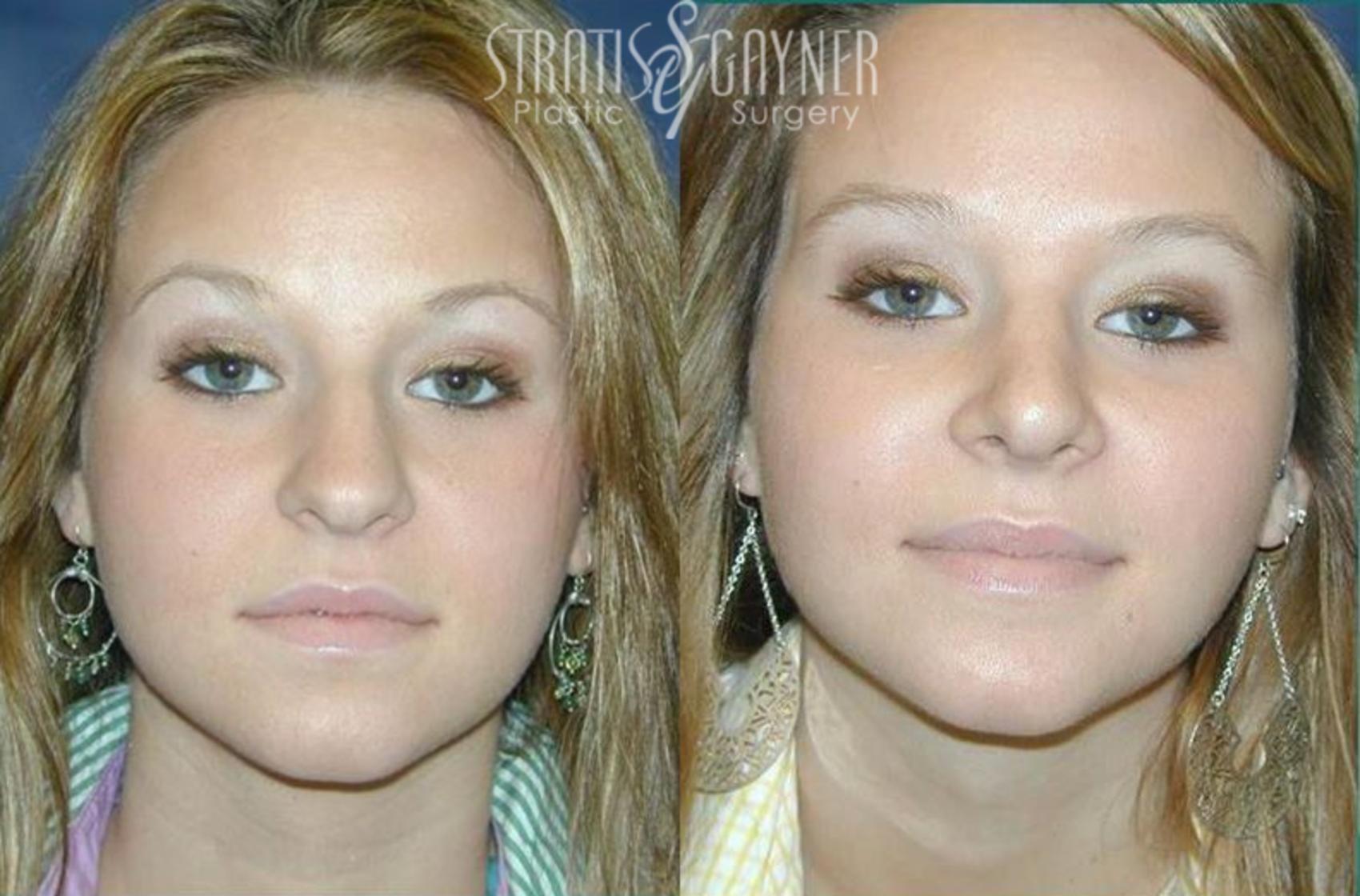 Before & After Rhinoplasty Case 66 View #1 View in Harrisburg, PA
