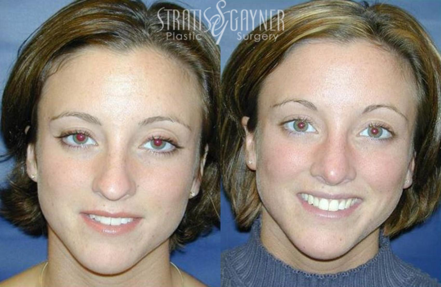 Before & After Rhinoplasty Case 67 View #1 View in Harrisburg, PA