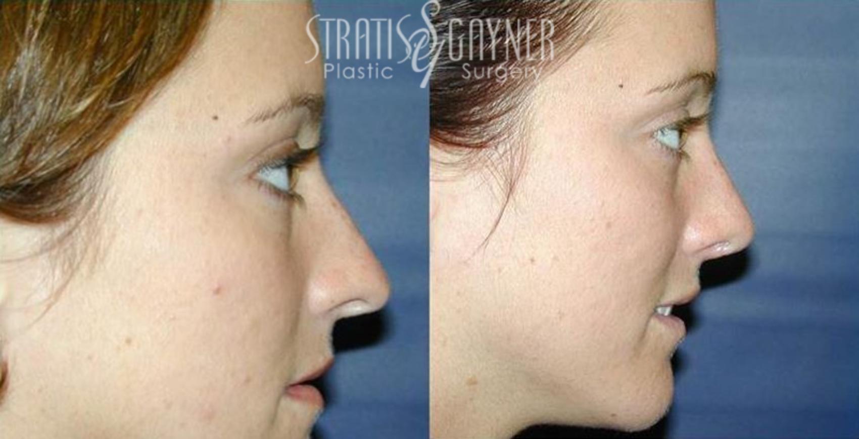 Before & After Rhinoplasty Case 68 View #1 View in Harrisburg, PA