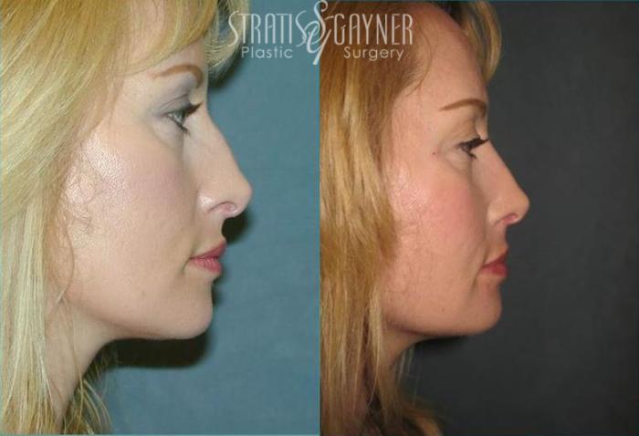 Before & After Rhinoplasty Case 69 View #1 View in Harrisburg, PA