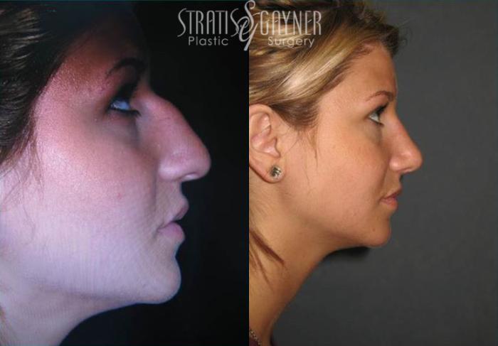 Before & After Rhinoplasty Case 70 View #1 View in Harrisburg, PA