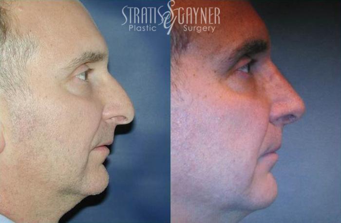 Before & After Rhinoplasty Case 71 View #1 View in Harrisburg, PA