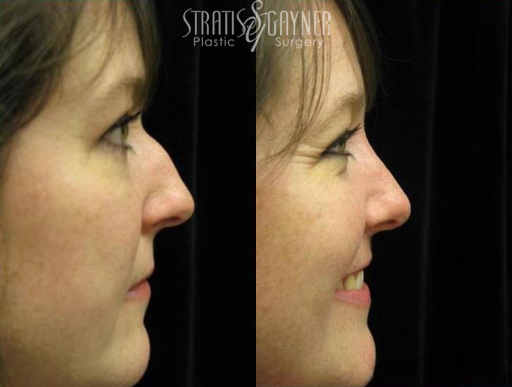 Before & After Rhinoplasty Case 73 View #1 View in Harrisburg, PA