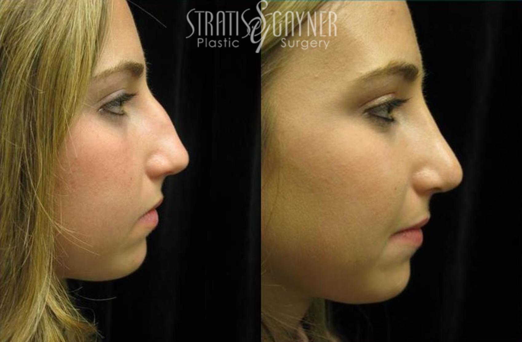 Before & After Rhinoplasty Case 74 View #1 View in Harrisburg, PA