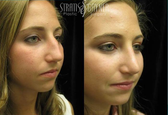 Before & After Rhinoplasty Case 74 View #2 View in Harrisburg, PA