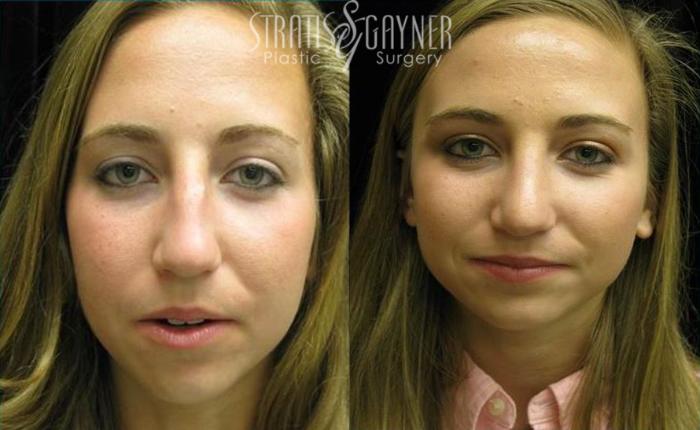 Before & After Rhinoplasty Case 74 View #3 View in Harrisburg, PA