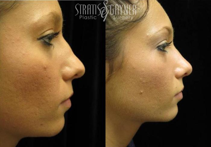 Before & After Rhinoplasty Case 75 View #1 View in Harrisburg, PA