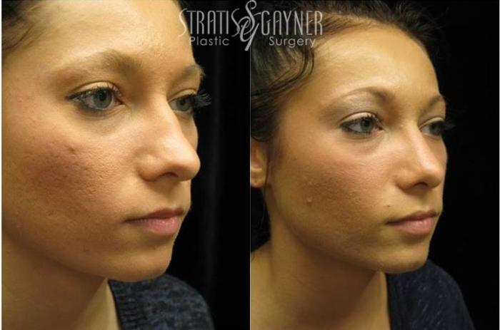 Before & After Rhinoplasty Case 75 View #2 View in Harrisburg, PA