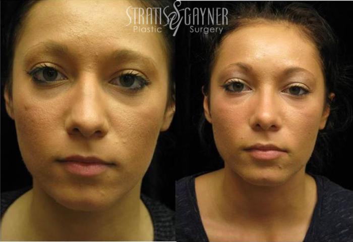 Before & After Rhinoplasty Case 75 View #3 View in Harrisburg, PA