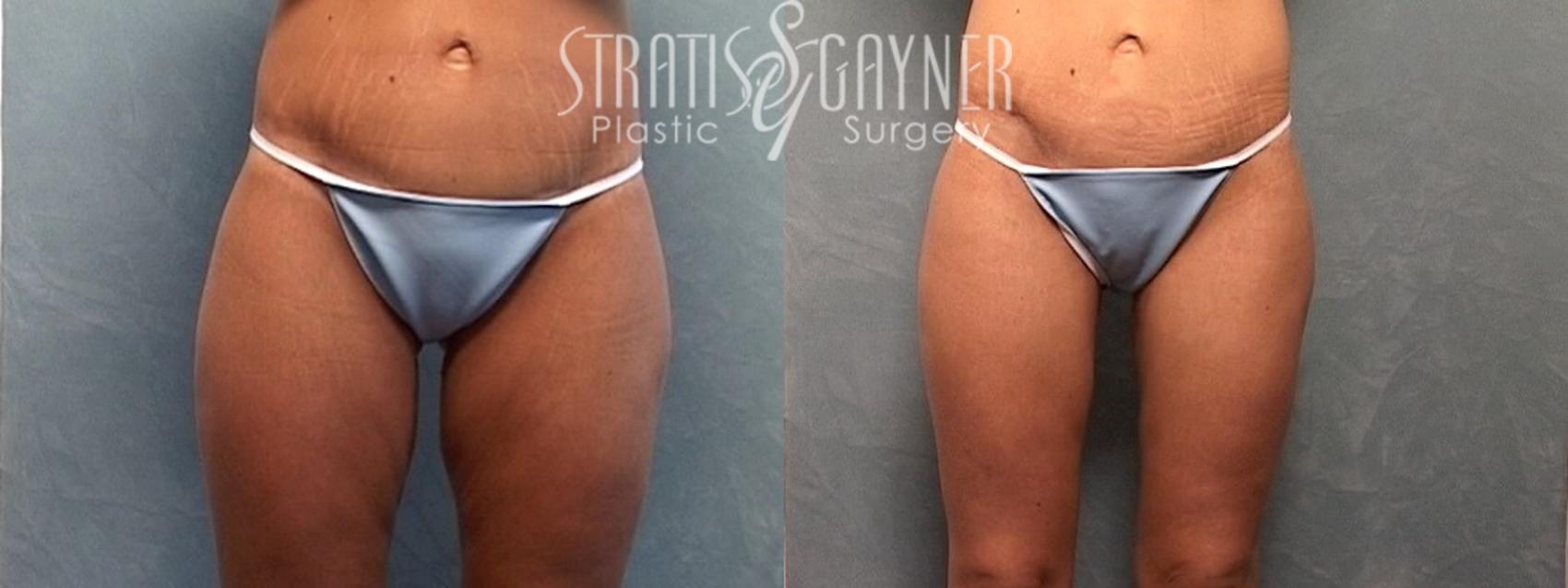 Deliberately not to mention Money lending Thigh Lift Before and After Photo Gallery | Harrisburg, PA | Stratis Gayner  Plastic Surgery