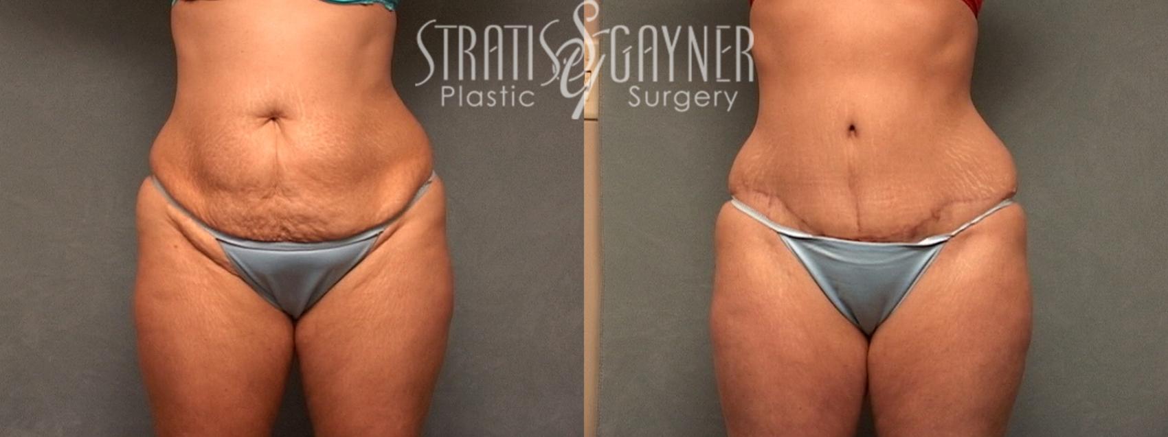 Before & After Tummy Tuck Case 134 View #1 View in Harrisburg, PA