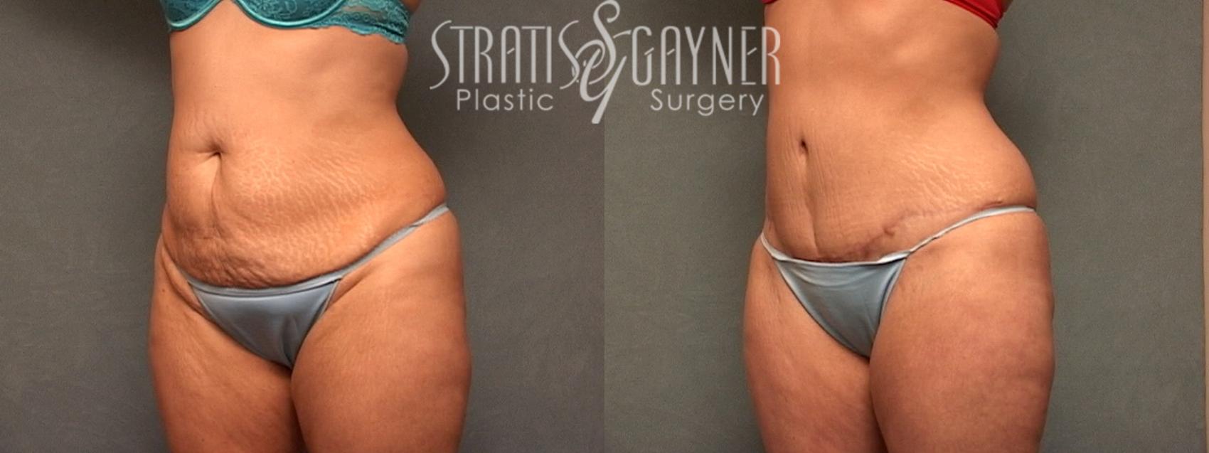 Before & After Tummy Tuck Case 134 View #2 View in Harrisburg, PA