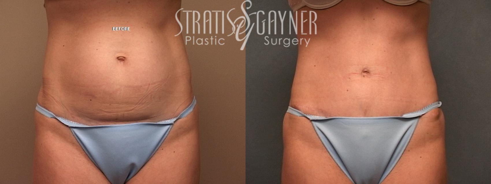 Before & After Tummy Tuck Case 135 View #1 View in Harrisburg, PA