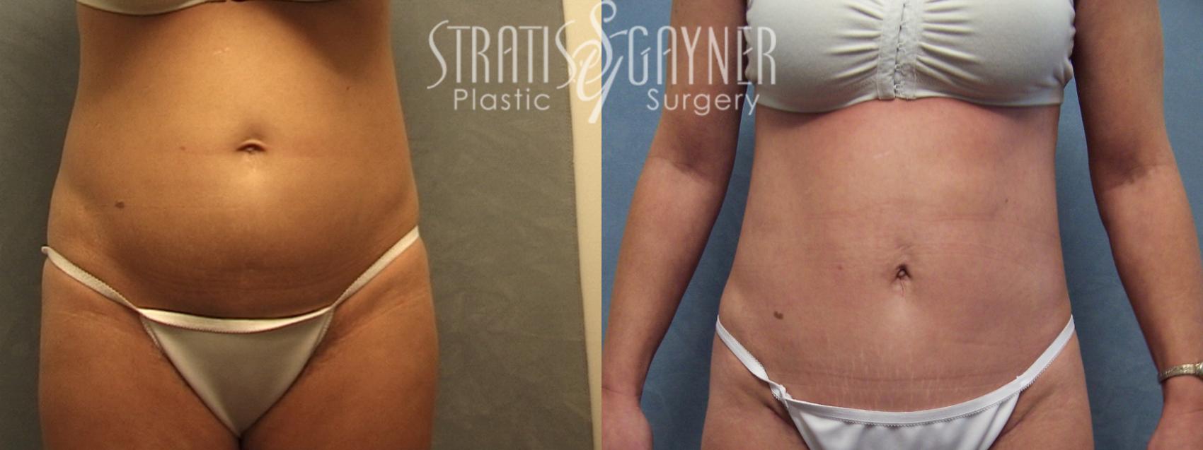 Before & After Tummy Tuck Case 151 View #1 View in Harrisburg, PA