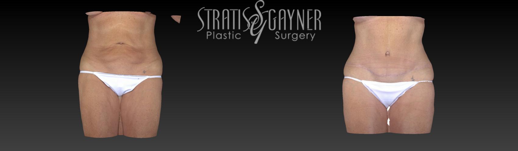 Before & After Tummy Tuck Case 194 View #1 View in Harrisburg, PA