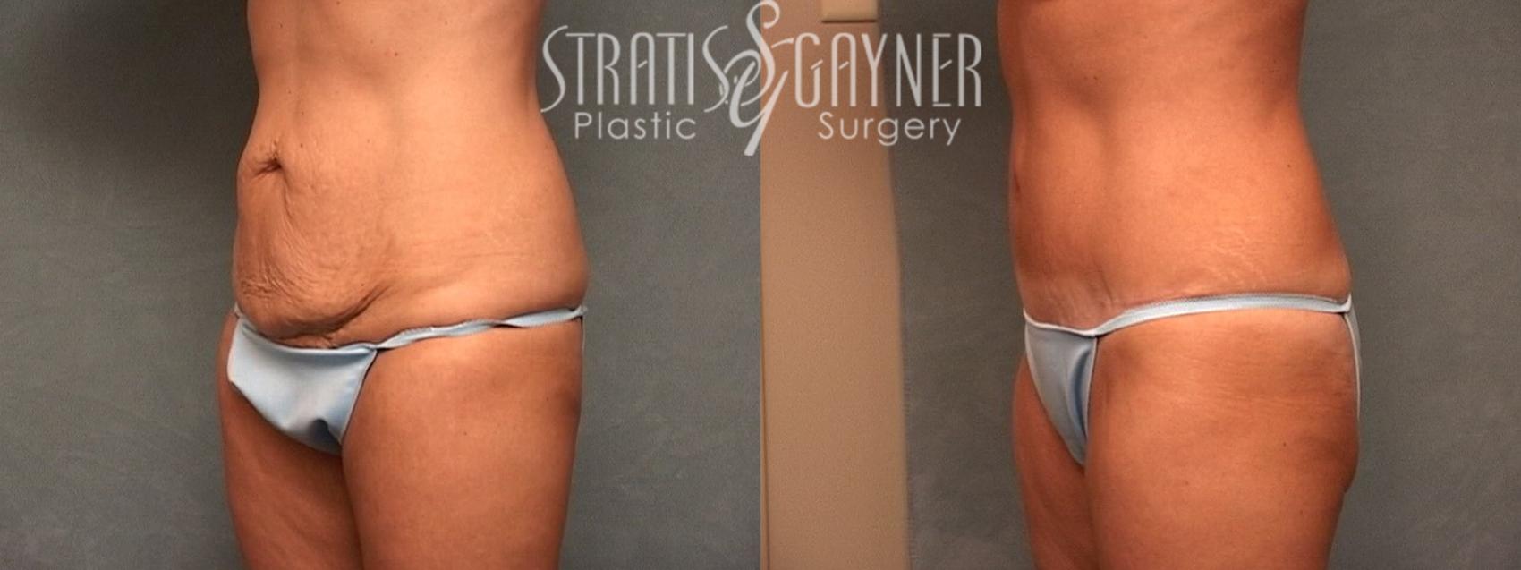 Before & After Tummy Tuck Case 22 View #2 View in Harrisburg, PA